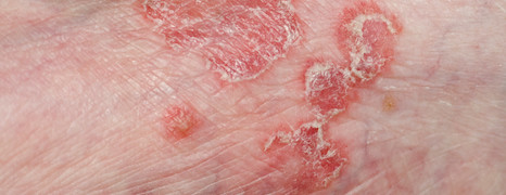 Pemphigus